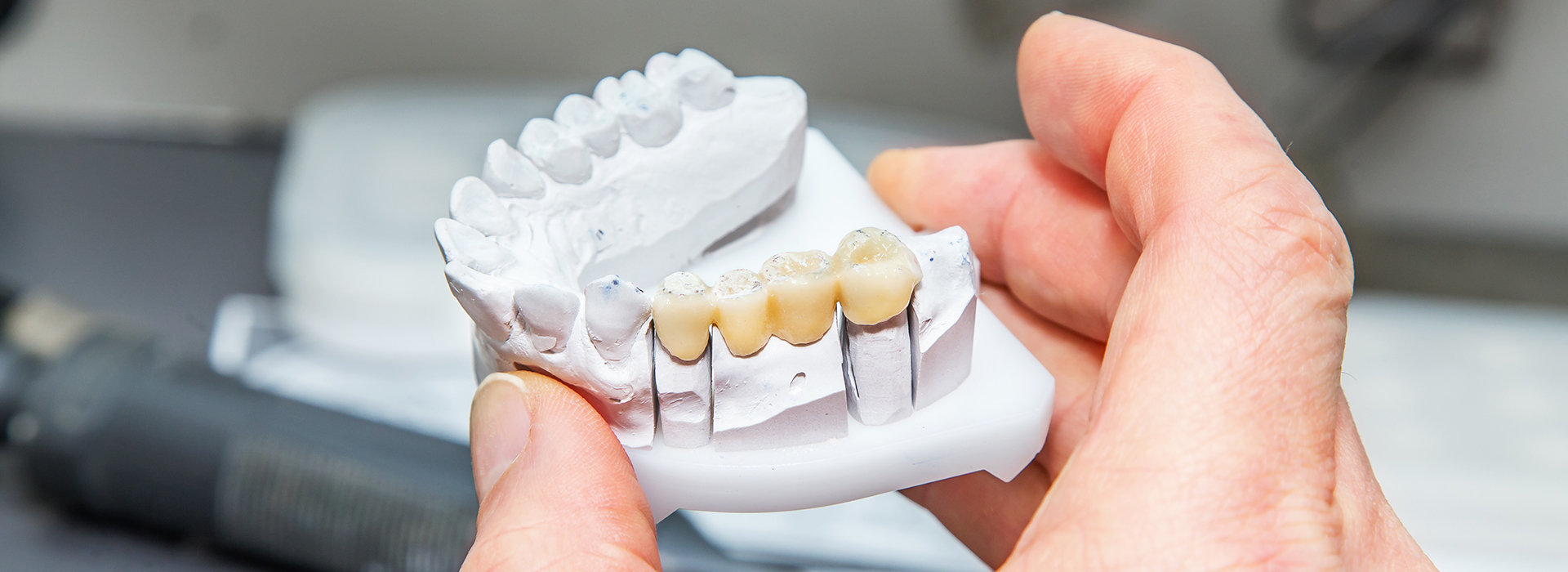 The image shows a person s hand holding a white dental model with visible teeth structures, likely used for educational purposes or as part of a dental training exercise.