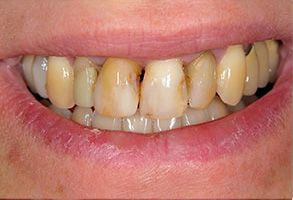 The image shows a close-up view of a person s mouth with yellowing teeth and a smile revealing some discoloration and possibly decay.